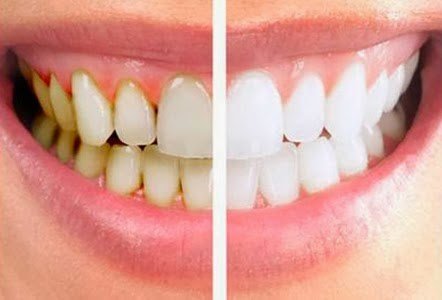 Cara Menghilangkan Gigi Kuning , Tips menghilangkan gigi kuning